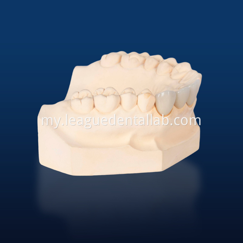 PFM,Metal crown,Fixed metal crown